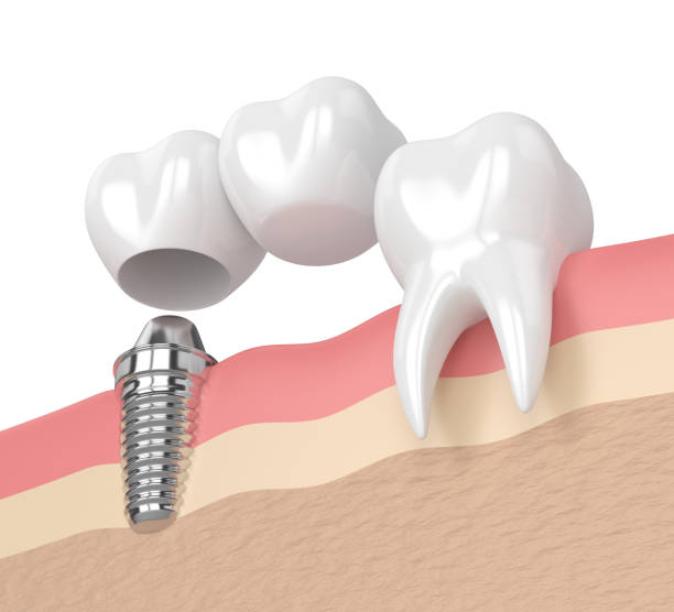 人工歯とインプラント体