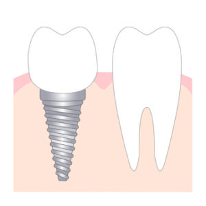 インプラントと天然歯のイラスト画像