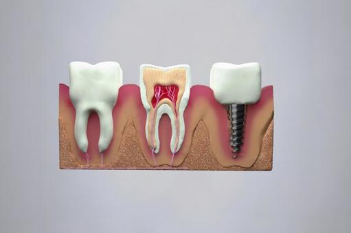 インプラントと周囲の歯