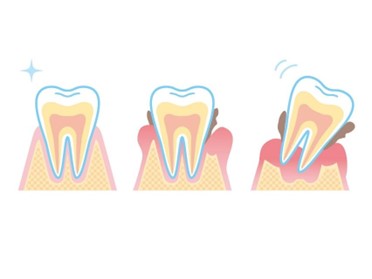 歯周病進行イラスト