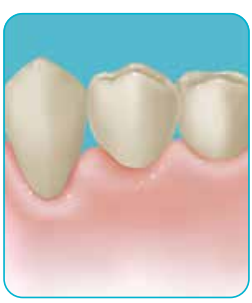 歯周病の歯茎