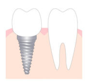インプラントと天然歯のイラスト画像
