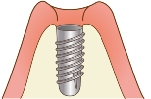 インプラント体