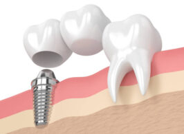 人工歯とインプラント体
