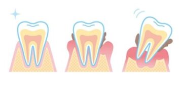 歯周病進行イラスト